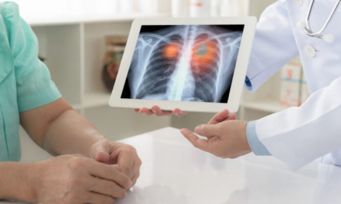 Καρκίνος του πνεύμονα: Πως τον επηρεάζει η νικοτίνη