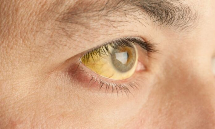 Κίτρινα μάτια: Τι σύμπτωμα είναι - Ποιοι πρέπει να προσέχουν