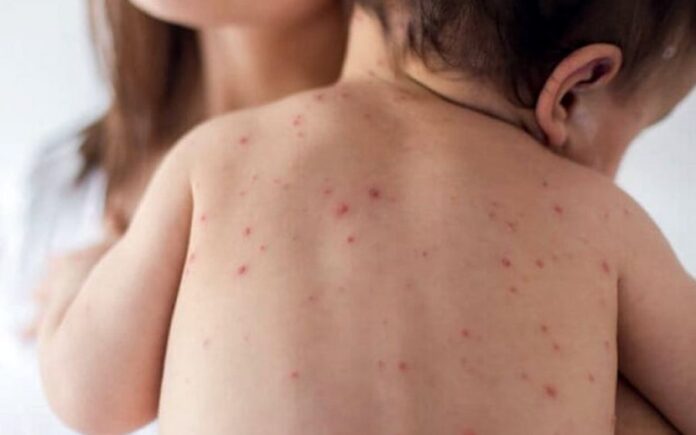 ΟΗΕ: Τα κρούσματα ιλαράς στον κόσμο τριπλασιάσθηκαν από τον Ιανουάριο