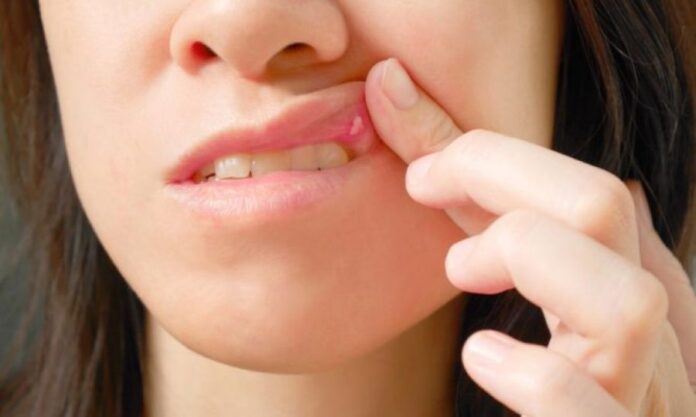 Καρκίνος του στόματος: Προσοχή στα πρώτα «αθώα» συμπτώματα